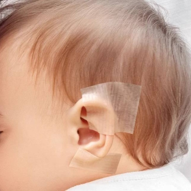 چسب اصلاح فرم گوش نوزاد کد 710