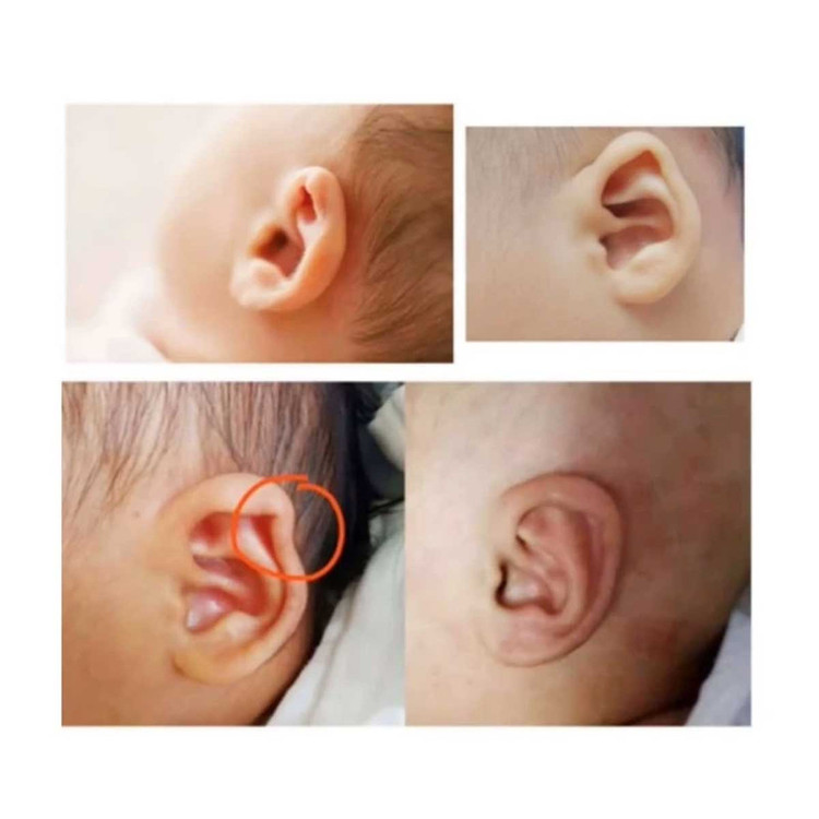 چسب اصلاح فرم گوش نوزاد مادرکر مدل 4/100